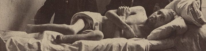 Amputations Amputations